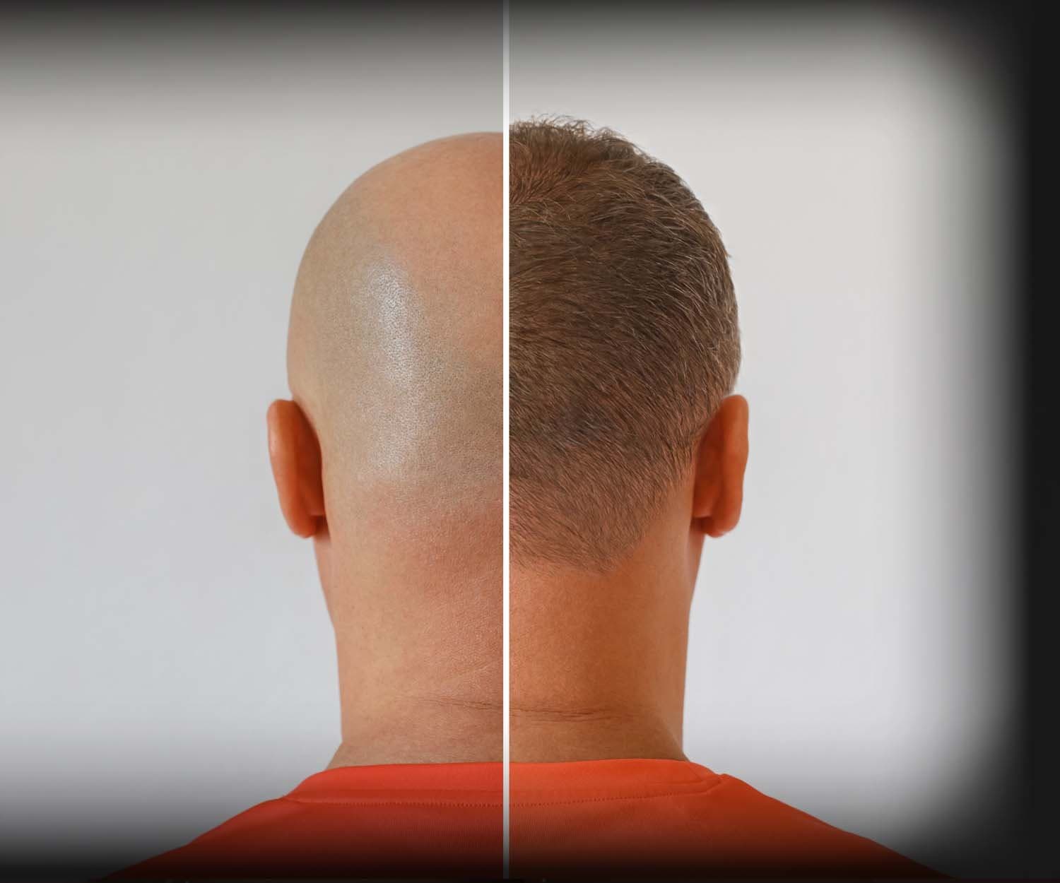 Vikramjeet Singh Dhingra - Hair Transplant Surgeon at Best Plastic Surgery India