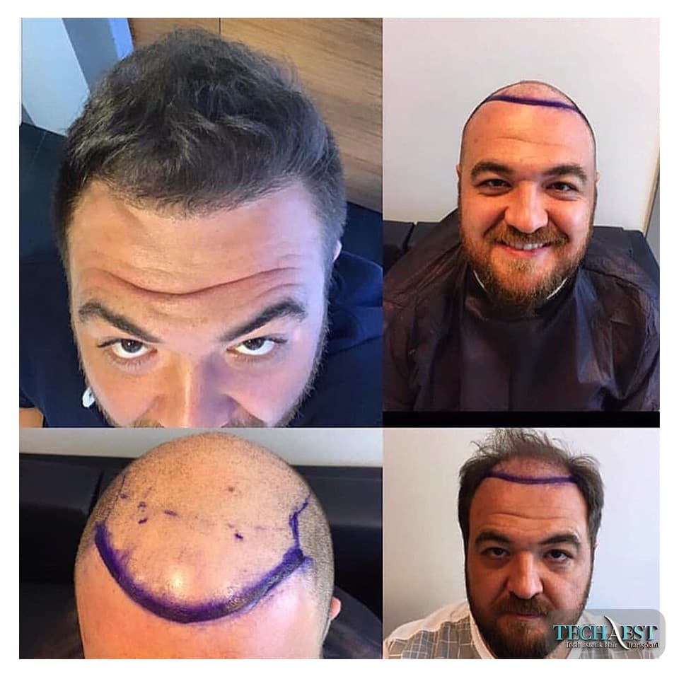Tech Estetik Saç Ekim Merkezi - Hair Transplant Surgeon at Techaest